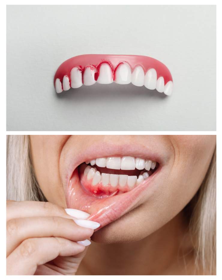 Bleeding Gum