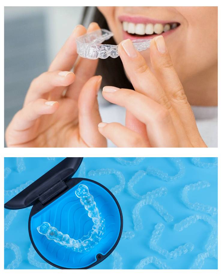 Dental Aligners