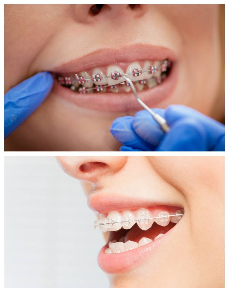 Dental Braces in Jayanagar
