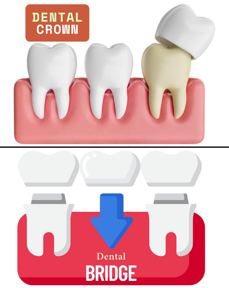 Dental Crowns and Bridges