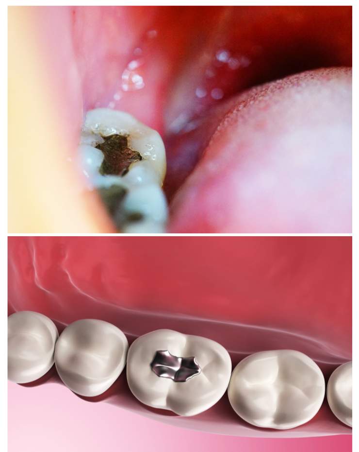 Dental Fillings