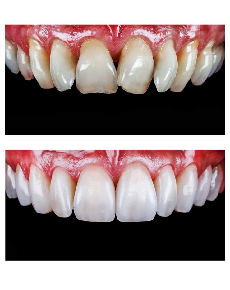 Dental Veneers