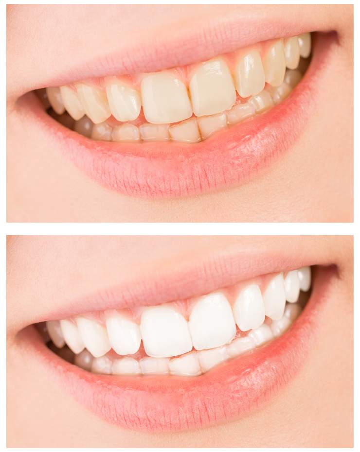 Dental Whitening