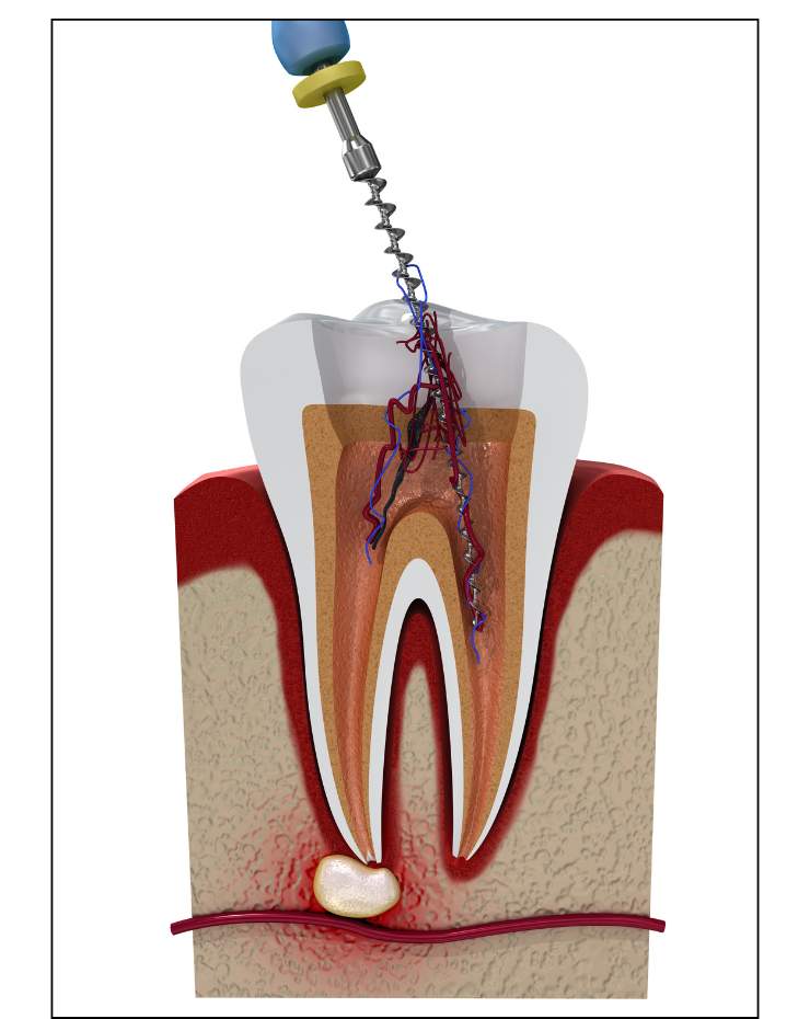 Root Canal Treatment