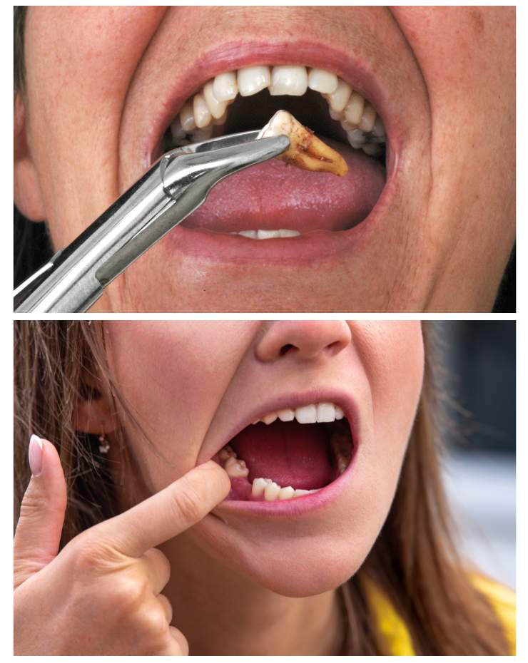 Tooth Extractions